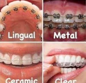 how much do braces cost in Nigeria