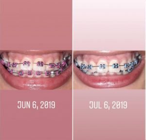 braces results after 1 month